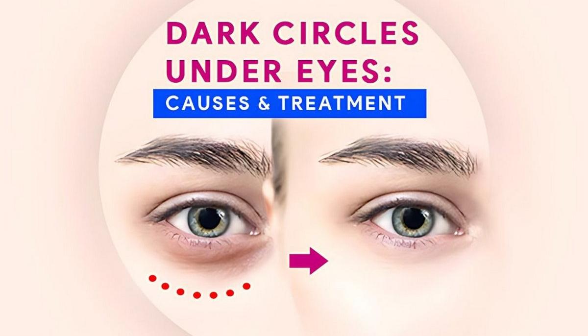 Dark Circles Under The Eyes: Causes & Treatments