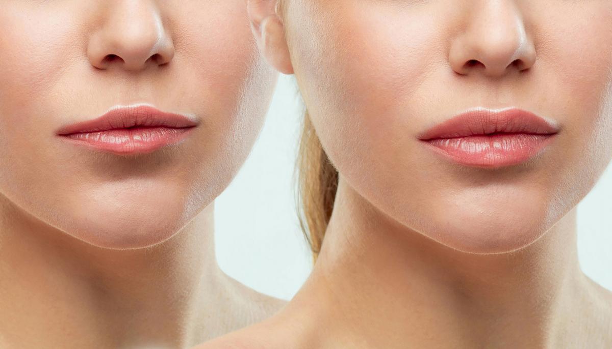 Do you use hyaluronic acid for lip augmentation? Important aspects to consider