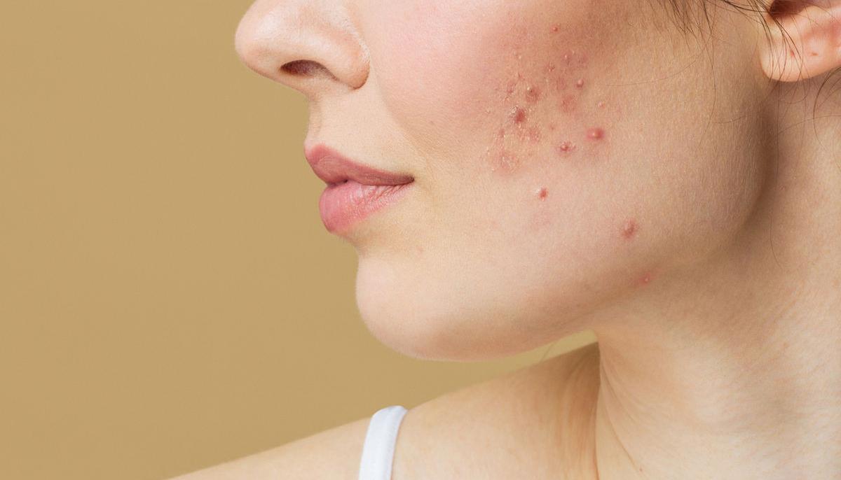 Acne, development factors and treatment