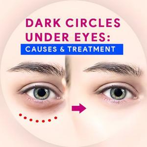 Dark Circles Under The Eyes: Causes & Treatments