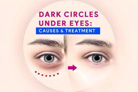 Dark Circles Under The Eyes: Causes & Treatments