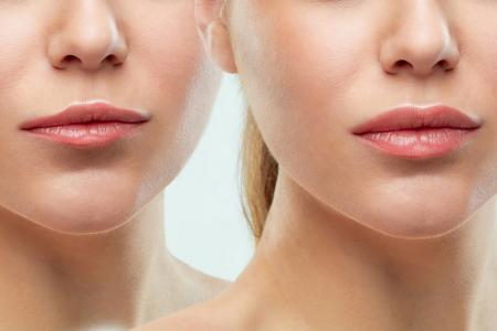 Do you use hyaluronic acid for lip augmentation? Important aspects to consider