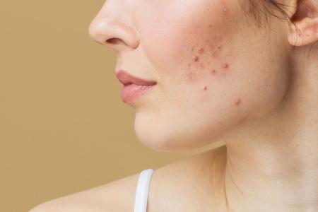 Acne, development factors and treatment