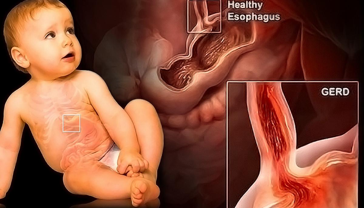 Gastroesophageal reflux in infants and children