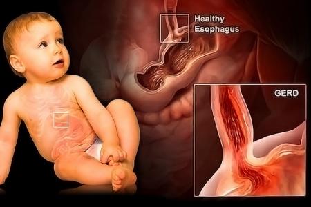 Gastroesophageal reflux in infants and children